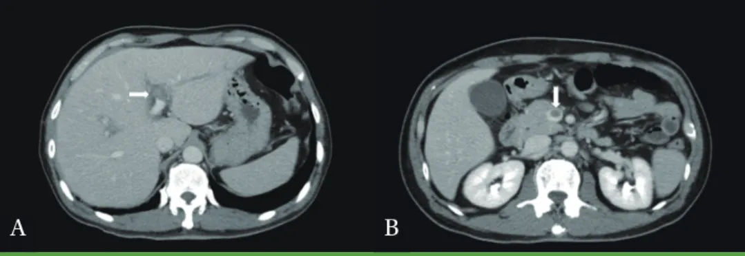 Figure 1. Enhanced computed tomography of abdomen and pelvis shows (A) thrombosis of left portal vein (arrow) and (B)  a thrombus in the lumen of the superior mesenteric vein (arrow) on venous phase.