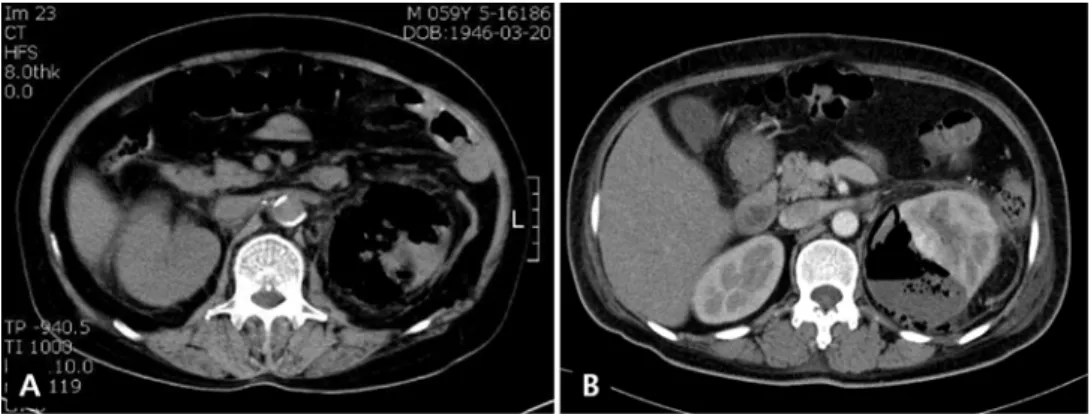 Figure 1. Abdominal CT findings in patients with emphysematous pyelonephritis. (A) Type 1 emphysematous pyelonephritis from 59-year old female shows the renal parenchymal necrosis and gas with absence of fluid content; (B) type 2 emphysematous pyelonephrit