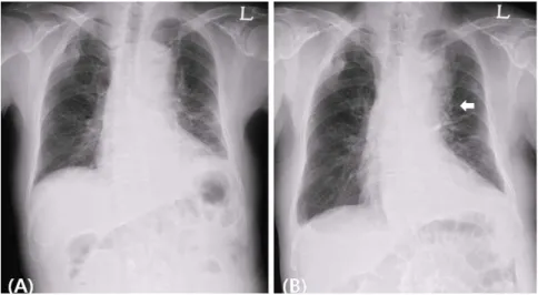 Figure 1. A) Chest X-ray on admission shows patchy and band-like increased  densities  in  left  lung