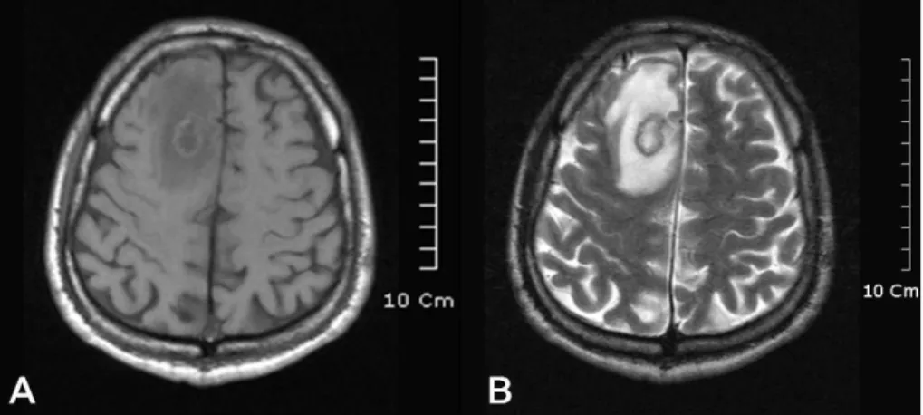 Figure  1.  Initial  magnetic  resonance  imaging.  (A)  2.2×1.8cm  sized  mass  lesion,  iso-signal intensity on T1 weighted image and (B) peripheral low signal intensity on  T2  weighted  image  with  peripheral  enhancement  on  right  frontal  lobe  wi
