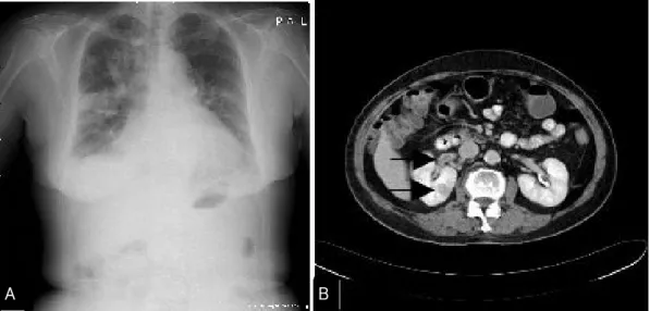 Figure 1. Chest x-ray shows small amount of pleural effusion and multiple nodular lesions in both lung  fields (A)