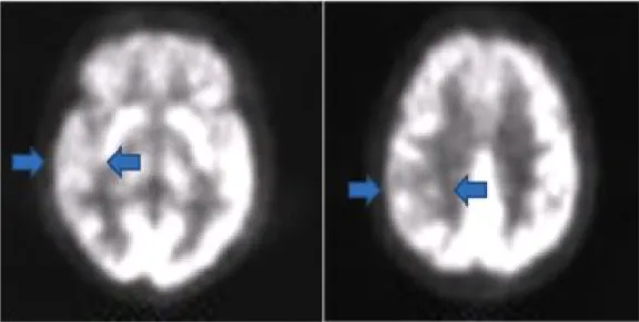 Figure 1. The patient’s brain PET imaging revealed that glucose metabolism decreased diffusely in  right temporal and parietal lobe