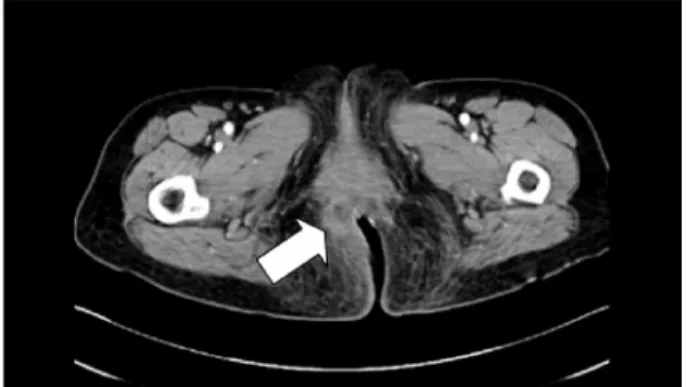 Figure 1. Pelvic CT scan revealed bilateral thickening of levator ani muscle around anus extending to the bilateral ischiorectal fascia (arrow), especially on right side, with focal nodular  infil-tration