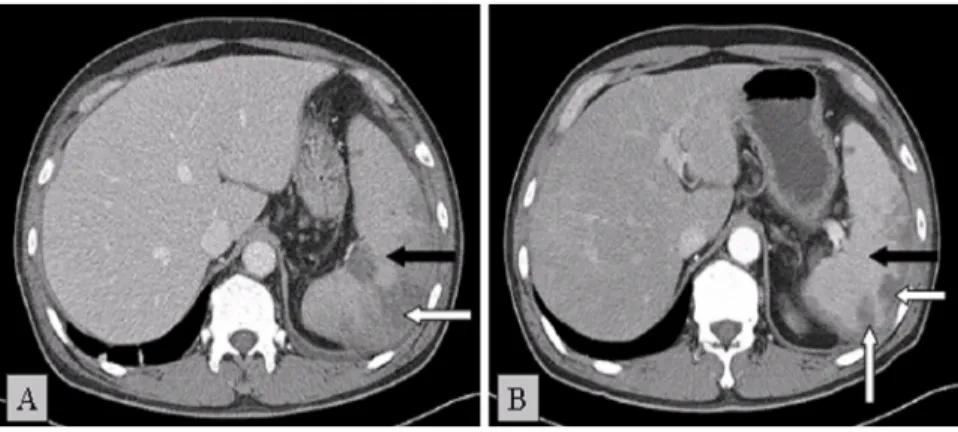Fig. 1. Abdominal CT on (A) day 3 and (B) day 9. Note the multiple areas of low attenuation density in the enlarged spleen (arrow) (A)