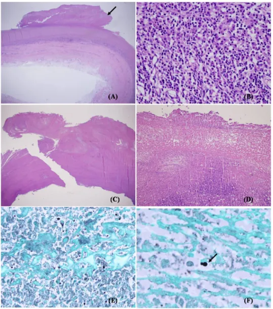 Fig. 1. Microscopic findings of the aneurysm with a thrombus (arrow). (A) (H &amp; E, x12.5) and marked infiltration of lymphocytes, plasma cells, and histiocytes in the wall (B) (H &amp; E, x400)