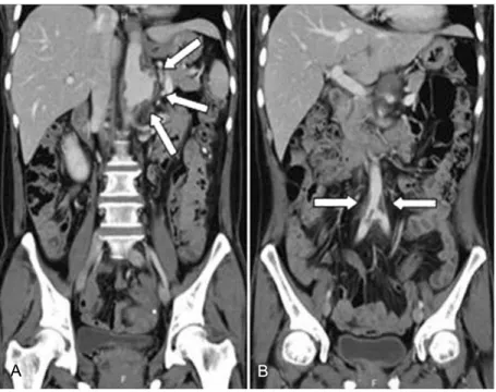 Fig. 3. Axial MDCT images demonstrate aneurysmal dilatation of proximal abdominal aorta associated with irregular circumferential thrombus and periaortic enhancement consistent with active mural disease (arrows in A)