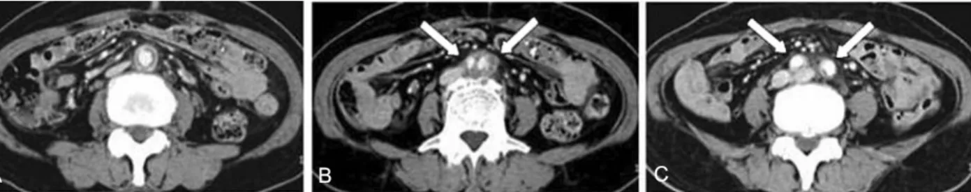 Fig. 5. MDCT with volume rendering (VR) reformation images nicely de- de-monstrate proximal abdominal aortic aneurysm (blue arrow in A) and irregular luminal narrowing in distal abdominal aorta and proximal both common iliac arteries (red arrows in A)