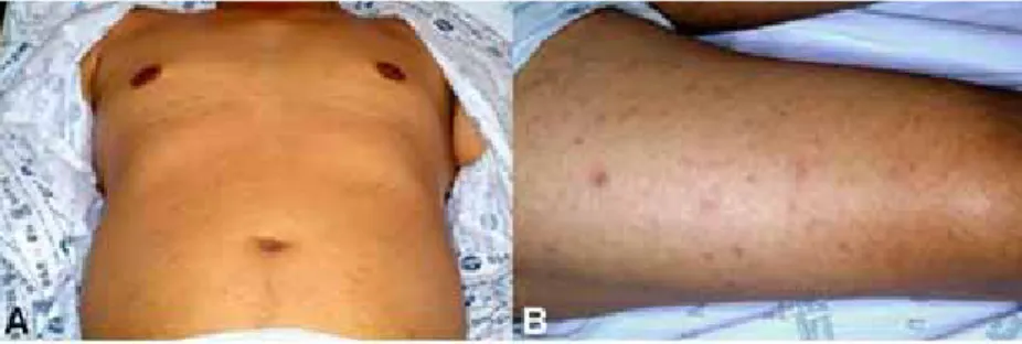 Figure 1. Maculopapular rash on trunk (A) and lower extremities (B) of tsutsugamu- tsutsugamu-shi patient.