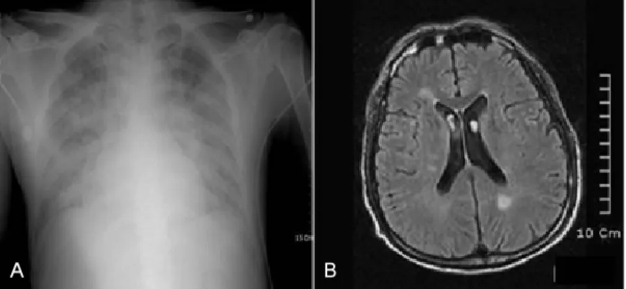 Figure 2. (A) Pneumonia on both lungs in case 2. (B) Multiple encephalitis in case 2.