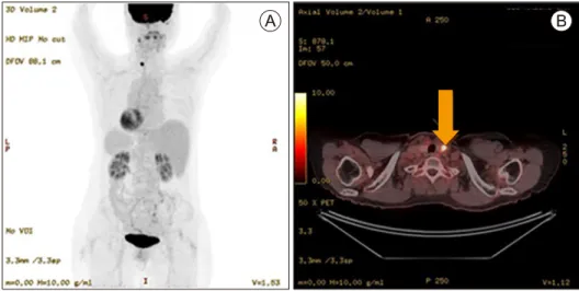 Fig. 1.  Positron  emission  tomography/computed  tomography  (PET/CT)  images  of  a  patient  with  papillary  thyroid  cancer.