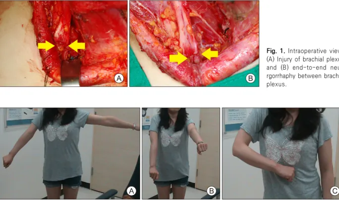 Fig.  2.  POD  6  months.  (A)  Arm  abduction,  (B)  shoulder  flexion  and  (C)  elbow  flexion