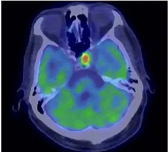 Fig.  2.  Interval  PET-CT  after  treatment  with  four  weeks  of  Lenvatinib,  showing  significant  reduction  in  size  and  FDG-avidity  of  metastasis