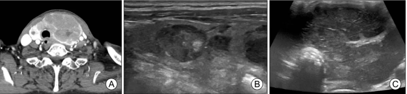 Fig.  1.  (A)  Neck  CT  reveals  about  4.3×6.6×8.3  cm  thyroid  mass  involving  the  left  lobe,  isthmus  and  medial  portion  of  the  right  lobe  and  resulting  in  tracheal  deviation