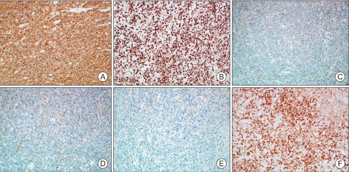 Fig.  5.  Immunohistochemical  staining  of  primary  thyroid  lymphoma.  Mass  shows  diffuse  strong  positivity  for  CD20  (A,  ×200).