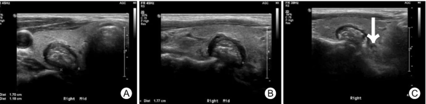 Fig. 1. The axial (A) and longitudinal (B) US scan of right thyroid lobe shows 17×12×18 mm sized isoechoic nodule with micro- micro-and  macrocalcification