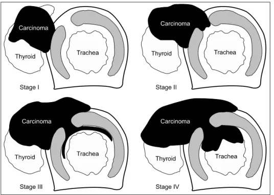 Fig.  1.  The  staging  system  for papillary carcinoma of the  thyroid  invading  the  trachea,  based on the histopathologic  extent  of  invasion