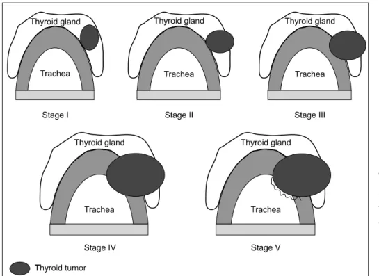 Fig. 2. Five  stages  of  aero- aero-digestive  tract  involvement  by invasive well-differentiated thyroid  carcinoma
