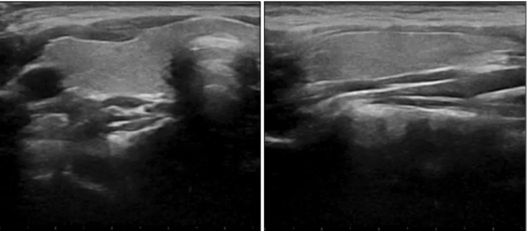 Fig.  1.  Initial  thyroid  ultrasonography  and  99m-Technetium  scintiscan.  (A)  Thyroid  ultrasonography  showed  an  ill-defined  hypoechoic nodule (1.0×0.5×1.5 cm) in the right lobe of the thyroid gland (indicated by white arrows)