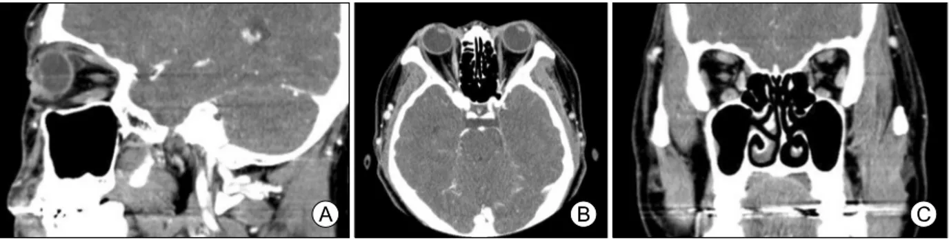 Fig. 2. Sagittal (A), axial (B) and coronal computed tomography of the orbits reveal enlargement of the bilateral extraocular muscles.