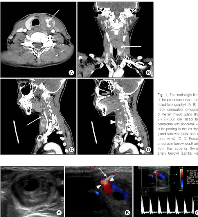 Fig. 2. The radiologic finding of the pseudoaneurysm (ultrasonography). (A) Ultrasonographic finding demonstrates heterogeneous  echogenic  swirling  mass  (2.3×1.9  cm)  in  the  left  thyroid  gland