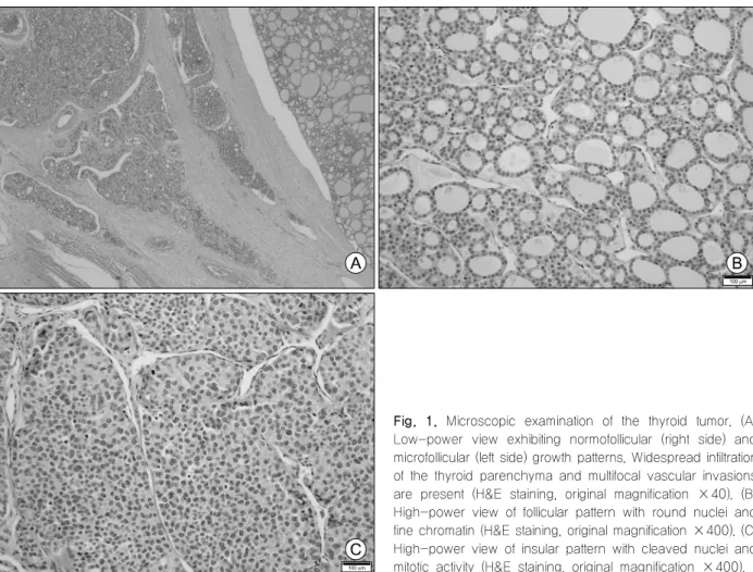 Fig.  1.  Microscopic  examination  of  the  thyroid  tumor.  (A)  Low-power  view  exhibiting  normofollicular  (right  side)  and  microfollicular (left side) growth patterns