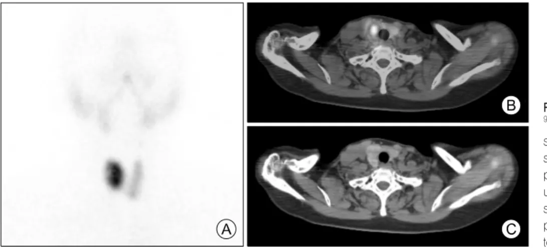 Fig.  1.  Thyroid  scan  (A),  