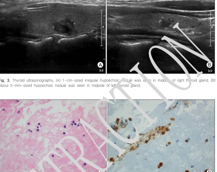 Fig.  3.  Thyroid  ultrasonography.  (A)  1-cm-sized  irregular  hypoechoic  nodule  was  seen  in  midpole  of  right  thyroid  gland