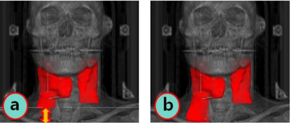 Fig. 1.   (a)	General	CT	scan	range,	(b)	Lack	of	CT	scan	range	for	plan