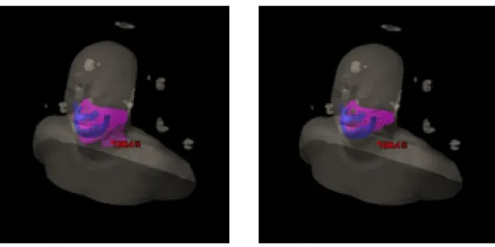 Fig. 3.  (a)	Image	of	evaluated	PTV	area,	(b)	Limited	PTV	with	internal	tooth	area