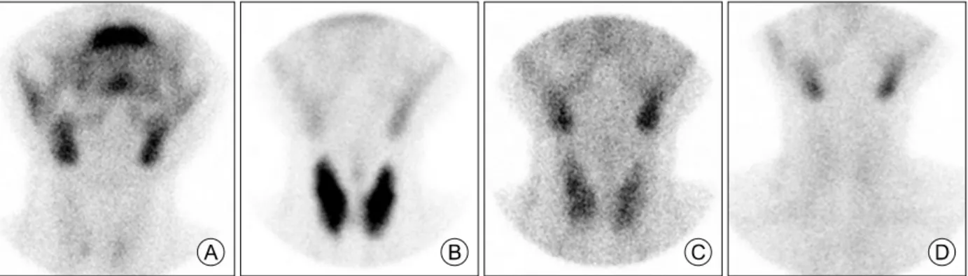 Fig. 1. Anterior view images of a Tc-99m pertechnetate scan in thyrotoxic phase. (A) Postpartum thyroiditis, (B) The first episode of hyperthyroidism, (C) The second episode of hyperthyroidism, (D) A relapse of postpartum thyroiditis