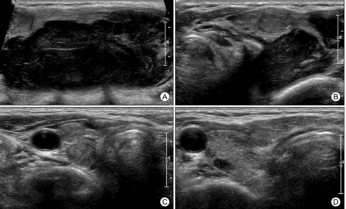 Fig. 1. Initial ultrasonography of thyroid. A huge lobulated contoured hypoechoic solid mass in left thyroid gland, measured 6.4×