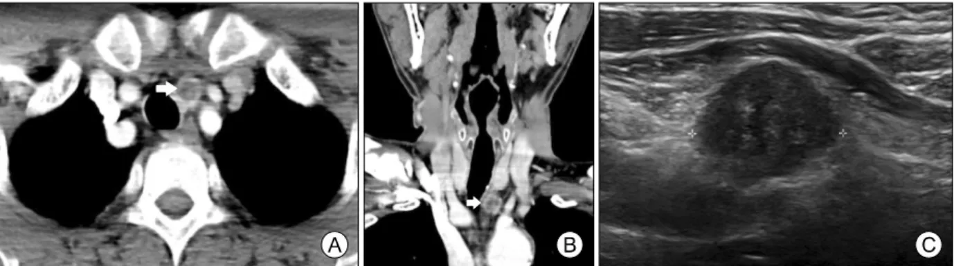 Fig.  1.  Preoperative  imaging  studies.  (A)  Axial  CT  scan  showing  an  about  1.5-cm-sized  well  defined  mass  with  peripheral  enhancement in left upper paratracheal area (arrow)