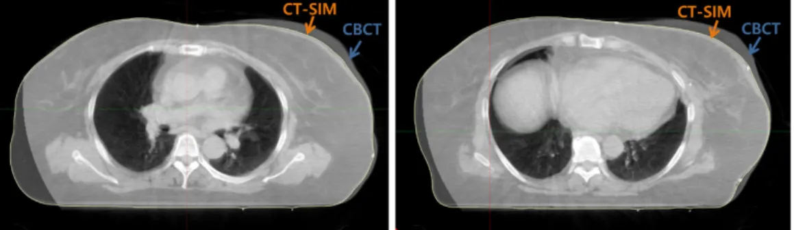 Fig. 1.  Image	registration	and	variation	of	breast	shape	during	RT