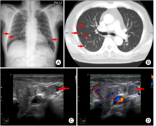 Fig.  1.  Radiologic  evalua- evalua-tions.  Multiple  small  nodules  (arrows)  were  found  in  lung  parenchyma,  which  showed  irregular shape, but  well-de-fined border on simple chest  X-ray (A) and chest CT scan (B)
