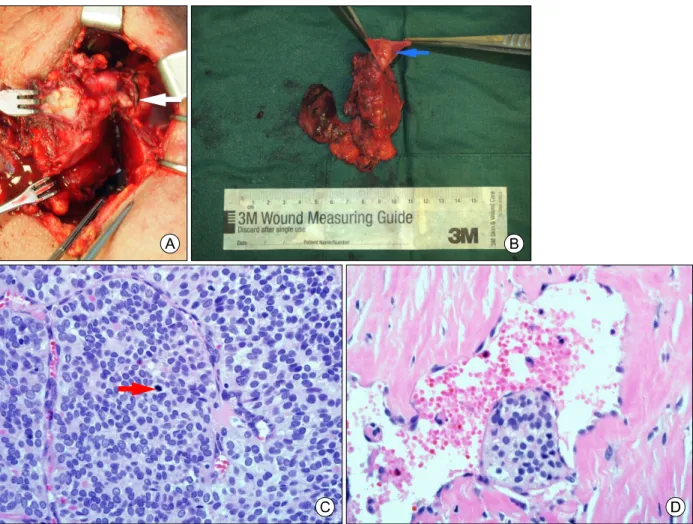 Fig. 2. Intraoperative and microscopic features. (A) A gross intraluminal tumor thrombus (arrow) are shown with hard and whitish tumor  mass  in  the  left  thyroid  lobe