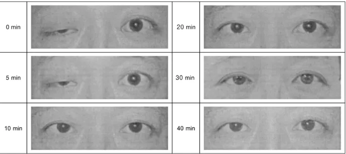 Fig.  1.  The  neostigmine  test.  After  neostigmine  injection,  transient  increasement  of  acetylcholine  at  neuromuscular  junction,  it  caused  transient  improvement  of  eyeball  movement  such  as  ptosis.