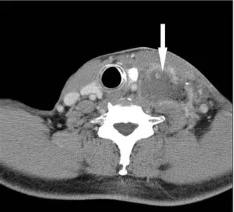 Fig. 1. Neck CT showing large mass in left lower neck carotid space,  metastatic  lymphadenopathy  and  left  thyroid  nodule.