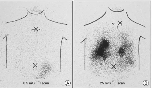Fig. 3. Diagnostic radioiodine scan  (A)  versus  scan  after  radioiodine  therapy  (B)