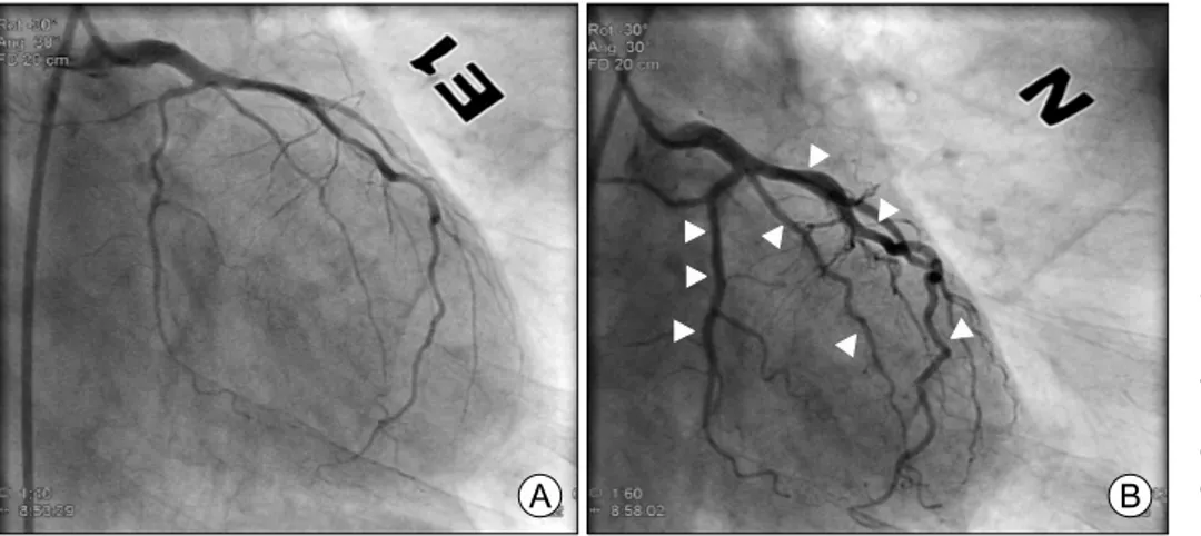 Fig.  1.  Angiograms  showing  the diffuse severe spasm that involved  the  left  coronary  artery (A)