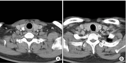 Fig. 1. Initial cervical CT scan shows  a  1.4-cm  calcified  nodule  at  the  mid-posterior  portion  of  the  right  thyroid  gland  (A)  and  a  1.5-cm  nodule with egg-shell  calcifi-cation at the low-lateral portion  of  the  left  thyroid  gland  (B)