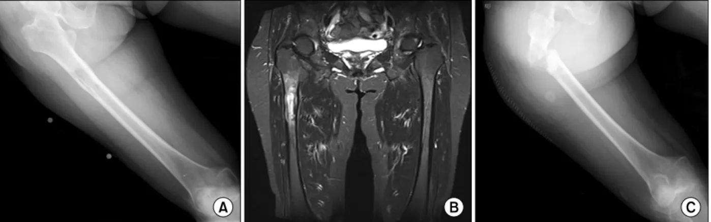 Fig.  1.  Femur  X-ray  and  MR  images.  (A)  The  X-ray  shows  ill-defined  osteolytic  bone  lesion  of  proximal  right  femur