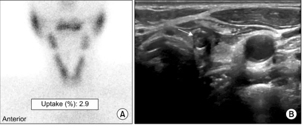 Fig. 3.   99m Tc-scan and thyroid ultrasonography images. (A) A thyroid scan  with  99m Tc reveal diffuse thyroid uptake (2.9%) and no cold area