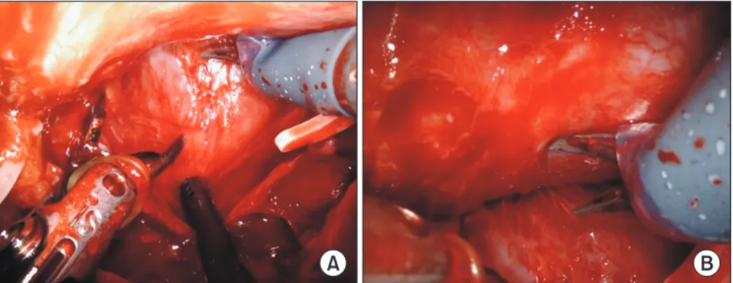 Fig. 5. (A) The 30 degrees down view is shown. The left vas deferens is retracted with the fourth arm and the right vas is retracted by the assistant