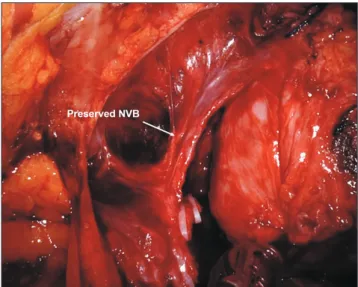 Fig. 6. Neurovascular bundle (NVB) separation. The NVB is completely  and easily saved by retrograde early release on the mid-prostate level