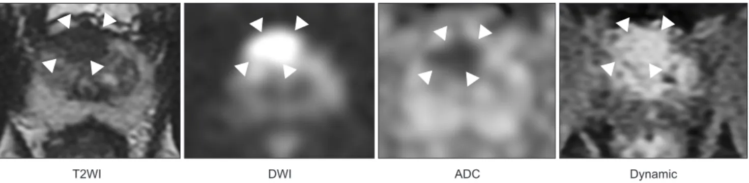 Fig. 1. mpMRI of a representative case suspected with prostate cancer. mpMRI includes a combination of high-resolution T2WIs, DCE images, DWIs, and  ADC