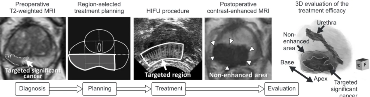 Fig. 5. Process of focal therapy for localized prostate cancer with high-intensity focused ultrasound