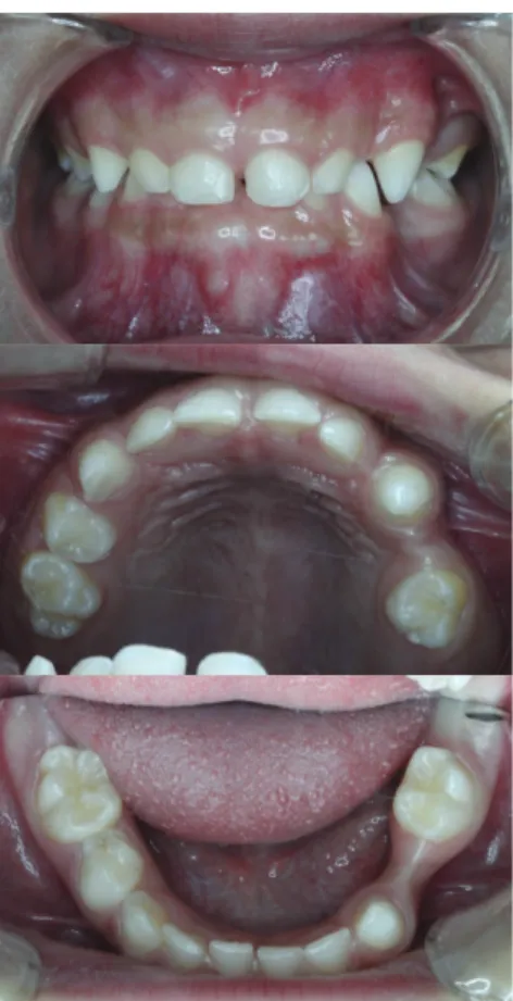 Fig. 3. Hyperpigmented lesions are seen on arm and left face.