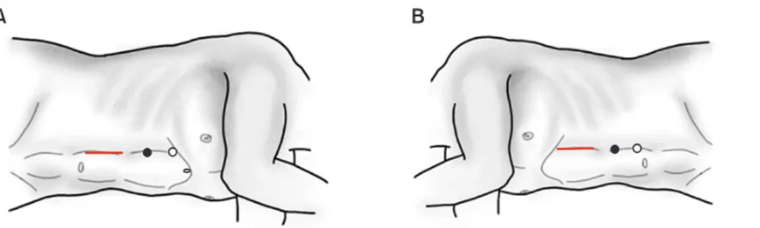 Fig. 1. Patients positioning and port placement. (A) Right side. (B) Left side.