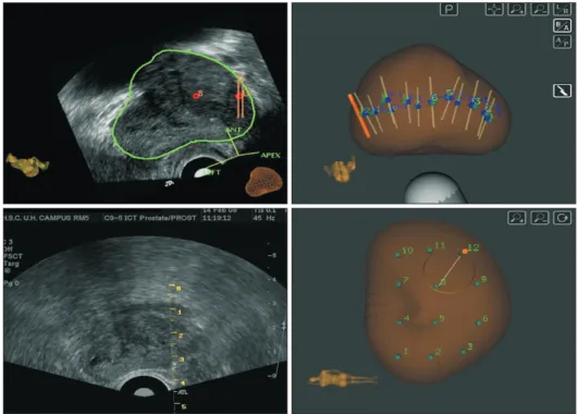 Fig. 2. Needle tracking of each core bi- bi-opsied. 