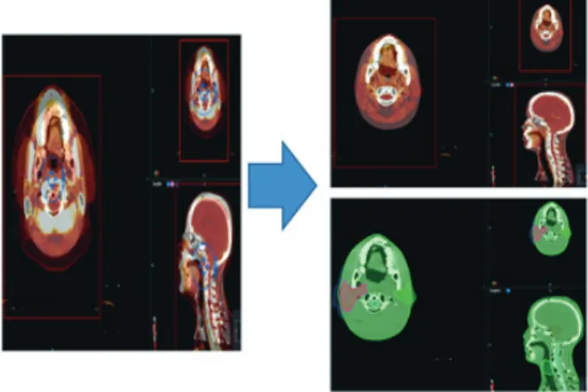 Fig. 2. Velocity(Varian	Medical	Systems,USA)를	통한	변형영상 정합(Deformable	registration)